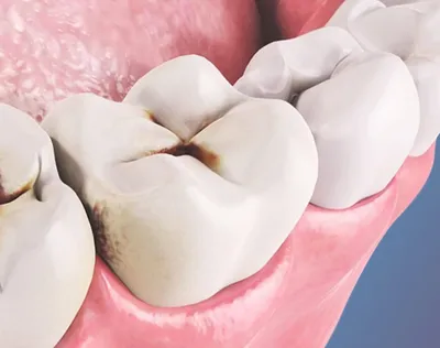 Скученность зубов: причины, степени, лечение| 3DMedica