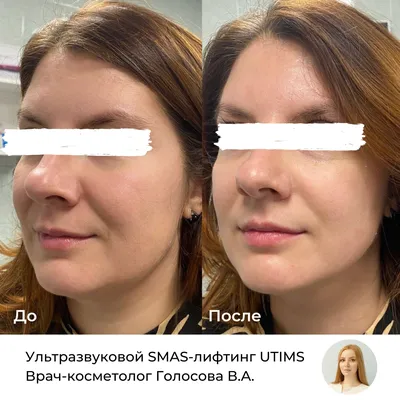 SMAS лифтинг Ультраформер III процедура в Санкт-Петербурге - клиника  Бьютидоктор