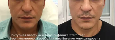 SMAS лифтинг лица Ultraformer | Клиника косметологии GEN 87 в Москве |  Цены, видео, фото до и после на сайте.
