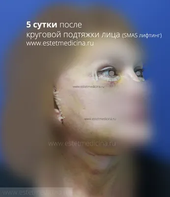 SMAS-лифтинг, СМАС: клиника, цена, фото, отзывы | Интернет-журнал  Estetmedicina.ru