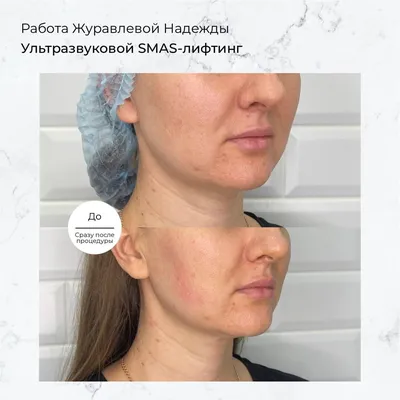 Липофилинг лица собственным жиром в Киеве - Coolaser Clinic