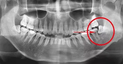 Удаление зуба мудрости без неприятных последствий | Клиника Колибри