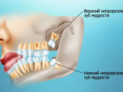 Что делать после удаления зуба мудрости?