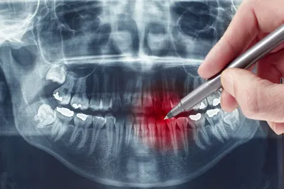 Что делать после удаления зуба - Стоматологическая клиника доктора Лапченко  - Блог