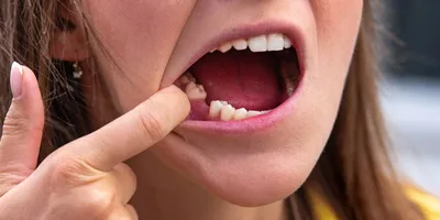 Осложнения после удаления зуба - какие могут быть, причины, симптомы,  лечение, профилактика