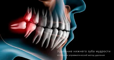 Удаление нижнего зуба мудрости [Цены, осложнения и уход после]