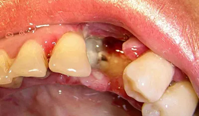 Осложнения после удаления зуба: парестезия, альвеолит, нарушения прикуса и  другие проблемы