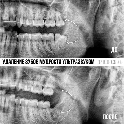 Удаление 8 зуба ультразвуком Piezosurgery®. Без боли. Центр Москвы