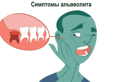 Что такое альвеолит зуба и как его лечить? | Silkdentist