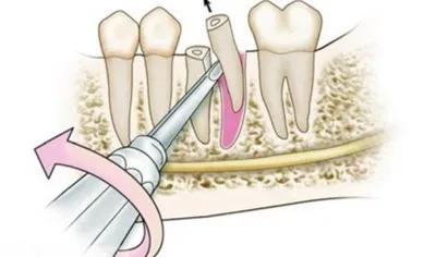 Осложнения после удаления зуба: что делать