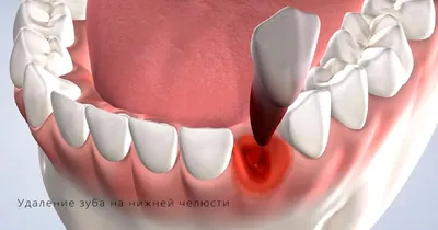 Удаление корня зуба - показания, подготовка к операции, инструменты, этапы  удаления, осложнения