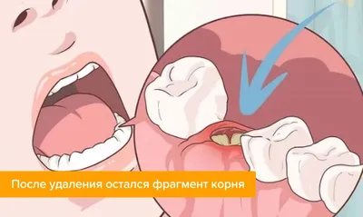 Как избежать осложнений после удаления зуба?