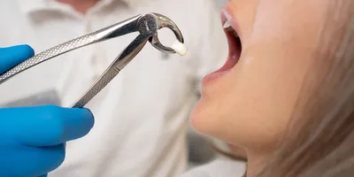 Удаление зуба с одномоментной установкой зубного имплантата