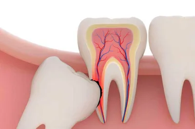 Последствия удаления зуба мудрости на нижней челюсти