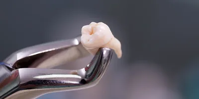 Гранулёма зуба - причины, диагностика и лечение