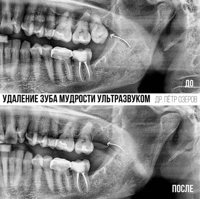ᐈ Удаление Зуба: Как Предотвратить Осложнения ᐈ Возможные последствия после  удаления зуба