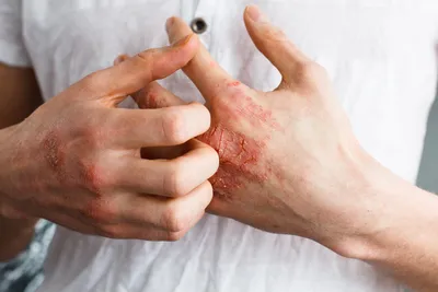 Экзема: причины, чем лечить и мазать, как выглядит экзема на руках, ногах,  лице и пальцах