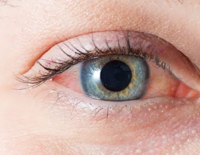 Вирусный конъюнктивит: лечение глаз, симптомы, причины, профилактика в  домашних условиях
