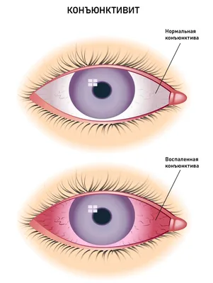 Конъюнктивит: причины, симптомы, признаки, осложнения, лечение, профилактика