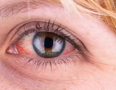 Неожиданный симптом в глазах указывает на «омикрон»