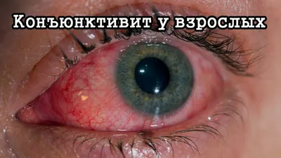 Конъюнктивит у взрослых – что это за болезнь, 💉 лечение, симптомы и 🔬  диагностика на МЕД Zoon