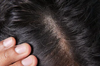 Псориаз волосистой части головы: симптомы, причины, лечение псориаза на  голове в Москве | Клиника АЛОДЕРМ | Клиника АЛОДЕРМ Москва