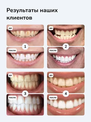 Отбеливание зубов в Danyliv Dental Practice ☎ (073) 900-31-30