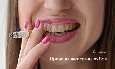 Отбеливание зубов в Трабзоне (отбеливание) - Dentomed