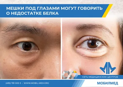 Диабетический макулярный отек (ДМО) – Bayer Pharmaceuticals Россия