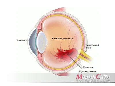 Гематома глаза: как избавиться от гематомы в домашних условиях