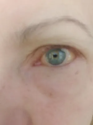 Синдром сухого глаза — симптомы, причины, диагностика, лечение