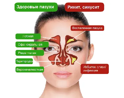 Гайморит: симптомы, причины, диагностика и лечение | Блог ЛДЦ Здоровье