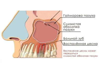 Гайморит у детей: симптомы и признаки, лечение, профилактика