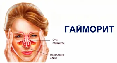 Лечение гайморита при грудном вскармливании в Москве