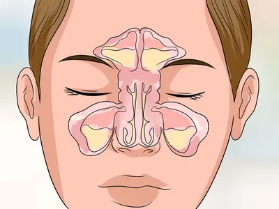 Синусит (гайморит) острый, симптомы - Клиника Здоровье 365 г. Екатеринбург