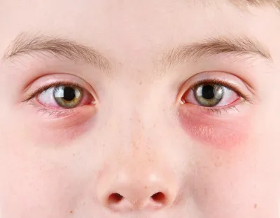 Аллергические отеки под глазами - как снять быстро