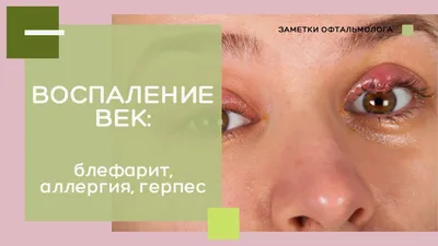 Отек века - описание, причины, симптомы, диагностика и лечение