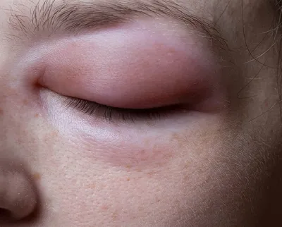 Малярные мешки под глазами: причины появления и способы лечения - блог Cleo  Line