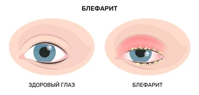 Чешутся уголки глаз - причины и лечение - Офтальмологические клиники  «Эксимер» (Киев) – диагностика и лечение заболеваний глаз у взрослых и детей