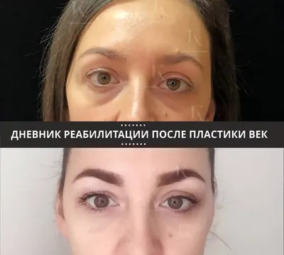 Спасение чувствительной и повреждённой кожи вокруг глаз с La Roche-Posay  Toleriane Ultra Eye Contour... Или не спасение? | Отзывы покупателей |  Косметиста