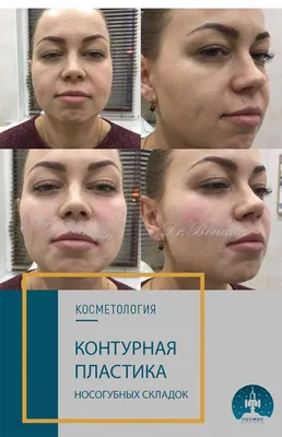 Ботокс (Botox) в носогубные складки в Санкт-Петербурге