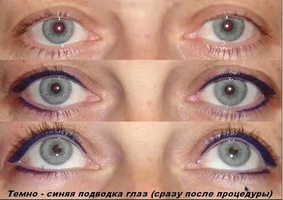 Шишка на веке (халязион) - причины и лечение - Офтальмологические клиники  «Эксимер» (Киев) – диагностика и лечение заболеваний глаз у взрослых и  детей Киев