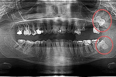 Удаление ретинированного (непрорезавшегося) зуба мудрости - «Стоит ли  удалять зуб в бесплатной клинике? Испытала на себе отличия удаления  ретинированного зуба мудрости от обычного.» | отзывы