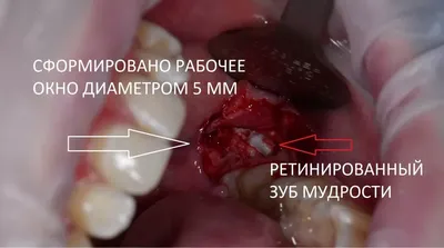 Безболезненное удаление зуба: цена в СПб