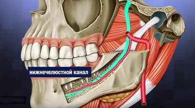 Удаление зуба мудрости сверху, снизу: показания, трудности, особенности  удаления воьмерки