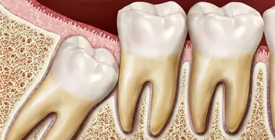 Как устранить отек после удаления ретинированного зуба мудрости