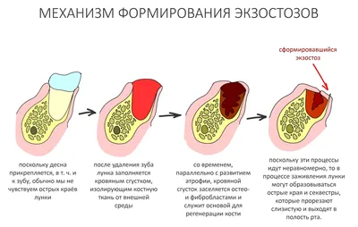 Перикоронит: удаление капюшона зуба мудрости в Москве - цена в стоматологии  «SmileLand»