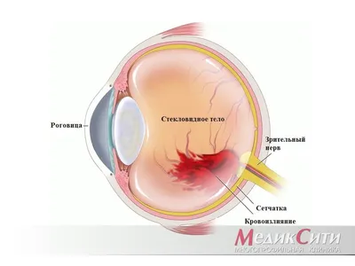 Отек склеры глаза фото фото