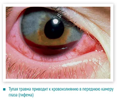 Особенности послеоперационного периода дренажной хирургии глаукомы uMEDp