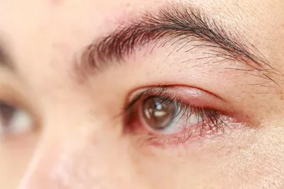 Как убрать нависшее веко над глазом | Клиника эстетической медицины  “Elevans”